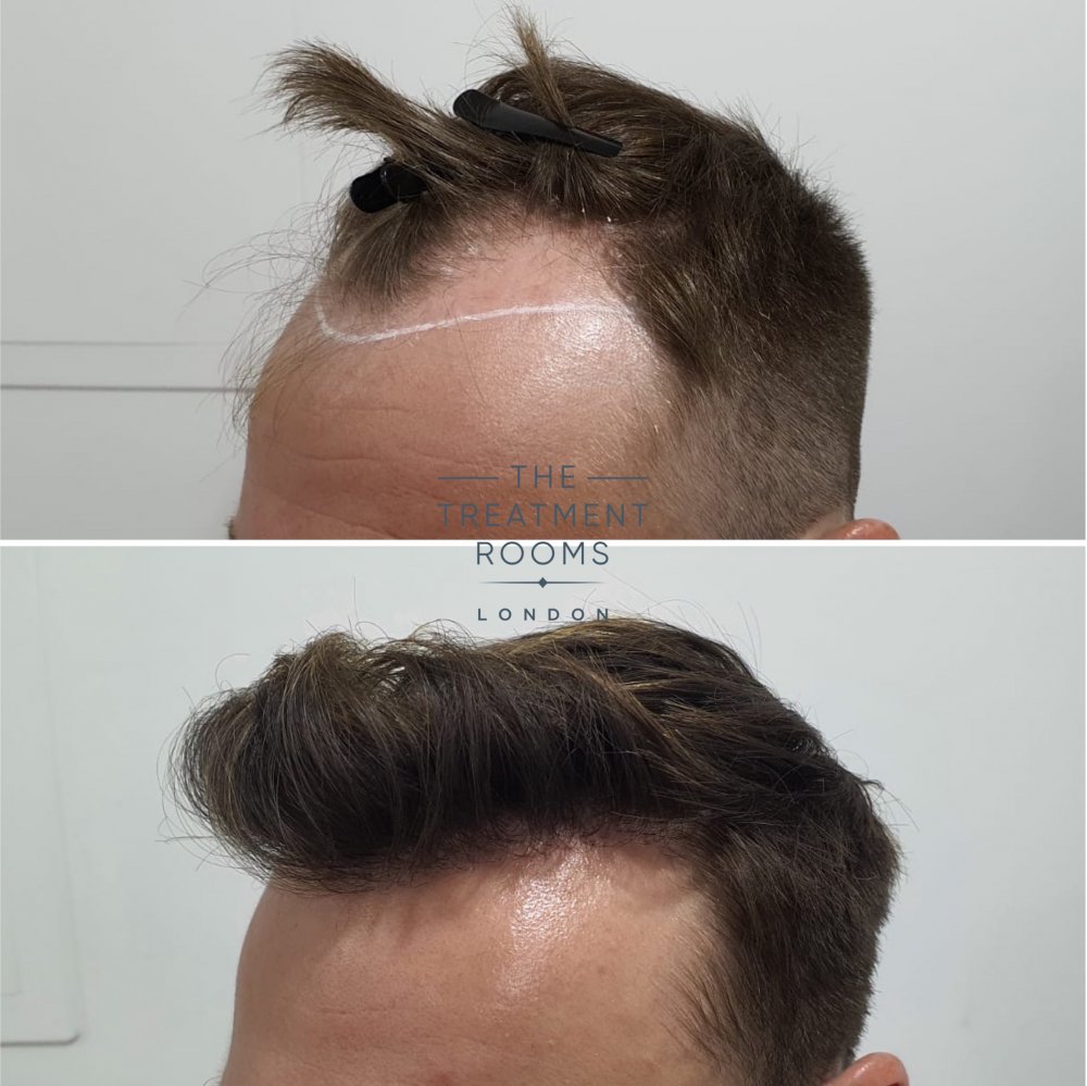 receding hairline dhi hair transplant before and after 1724 grafts.jpg