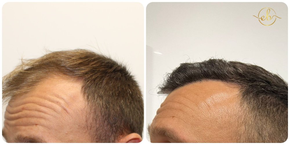Receding-hairline-fue-dr-bonaros-glasgow.jpg