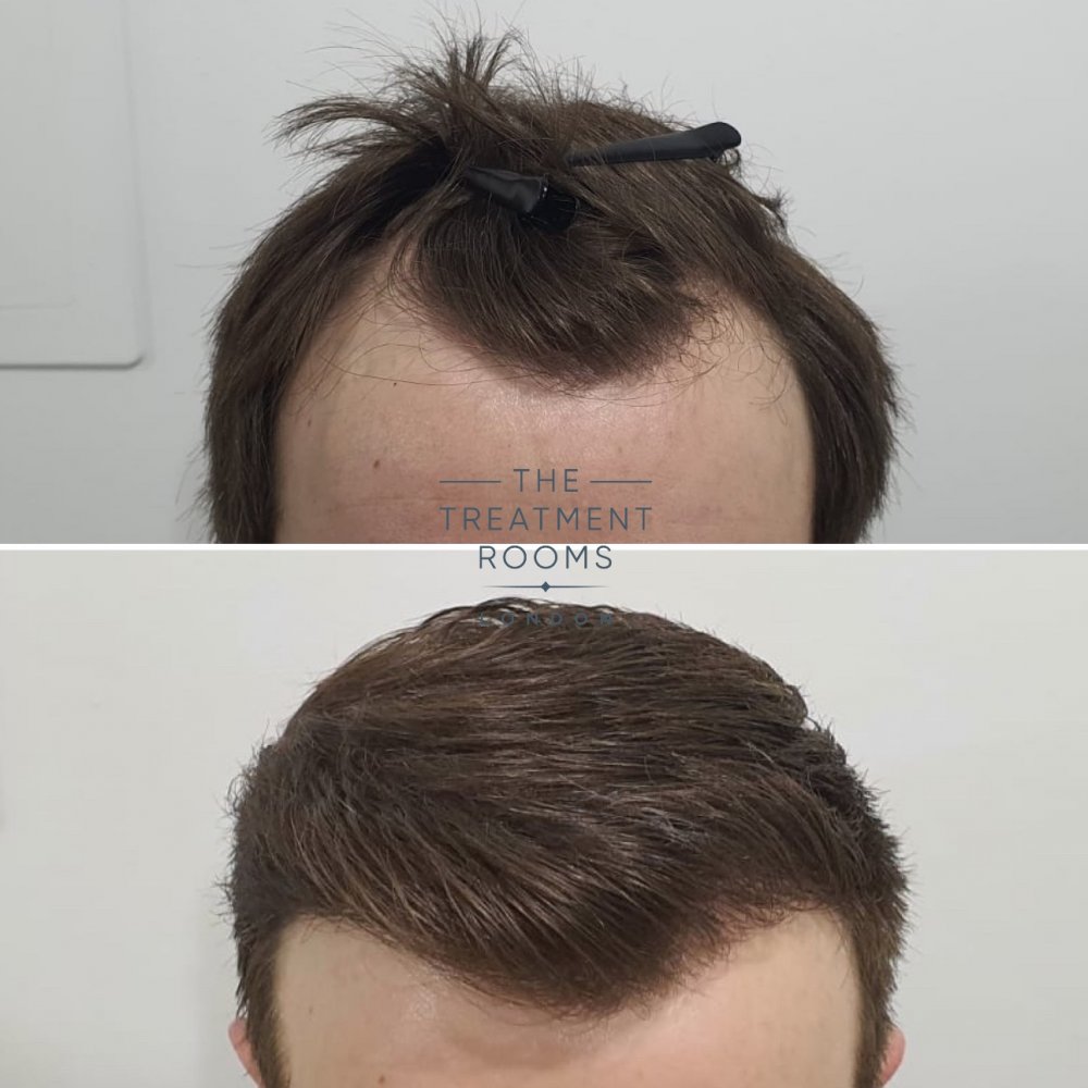 Receding hairline FUE hair transplant 1100 grafts.jpg