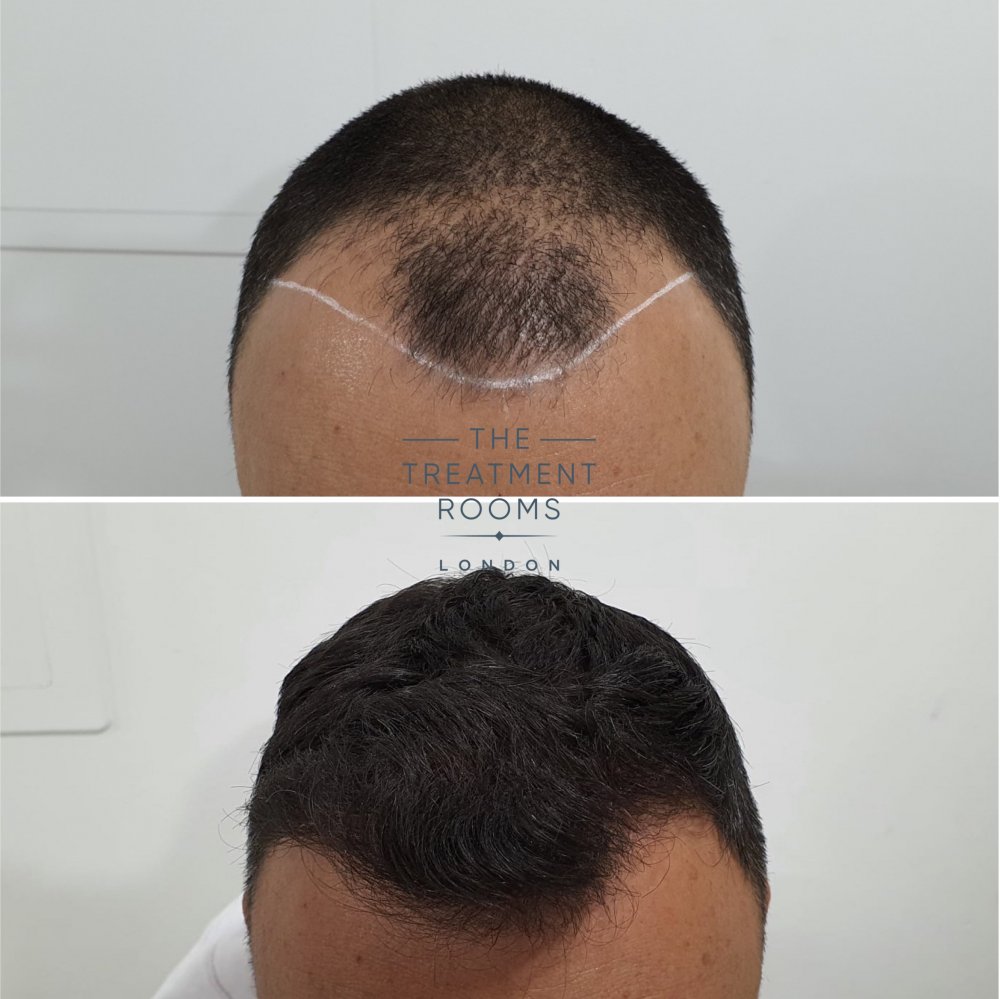 Receding hairline FUE hair transplant before and after 1498 grafts.jpg