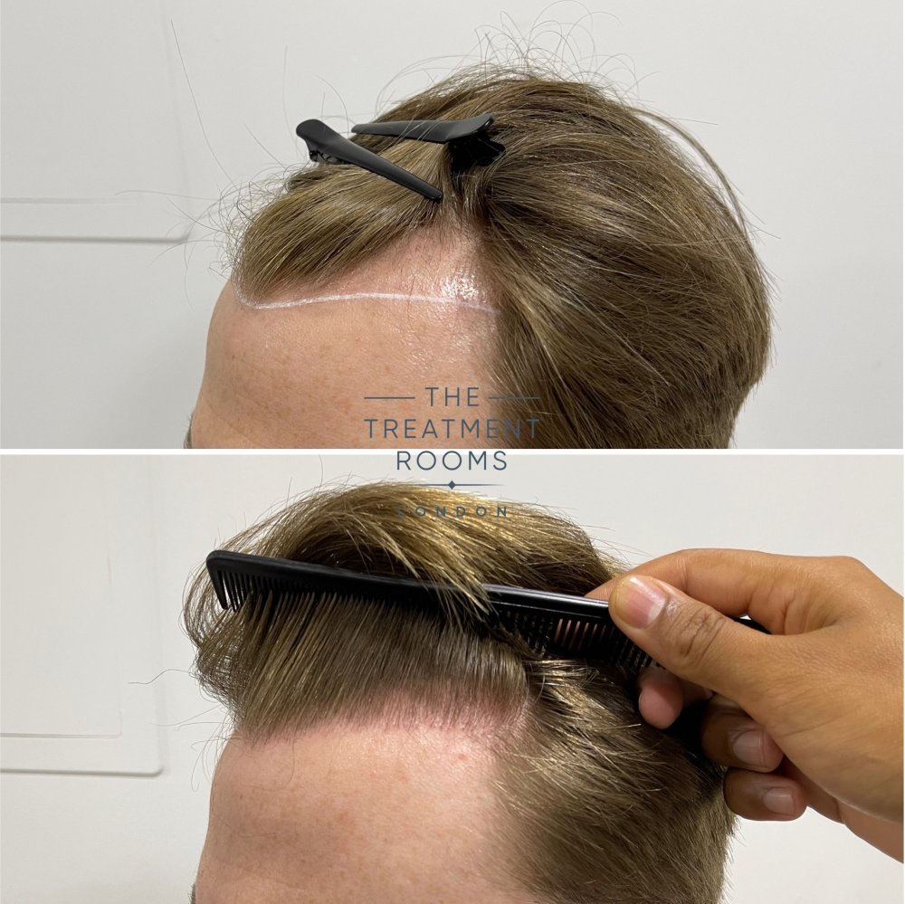 receding hairline fue hair transplant before and after 1700 grafts.jpg