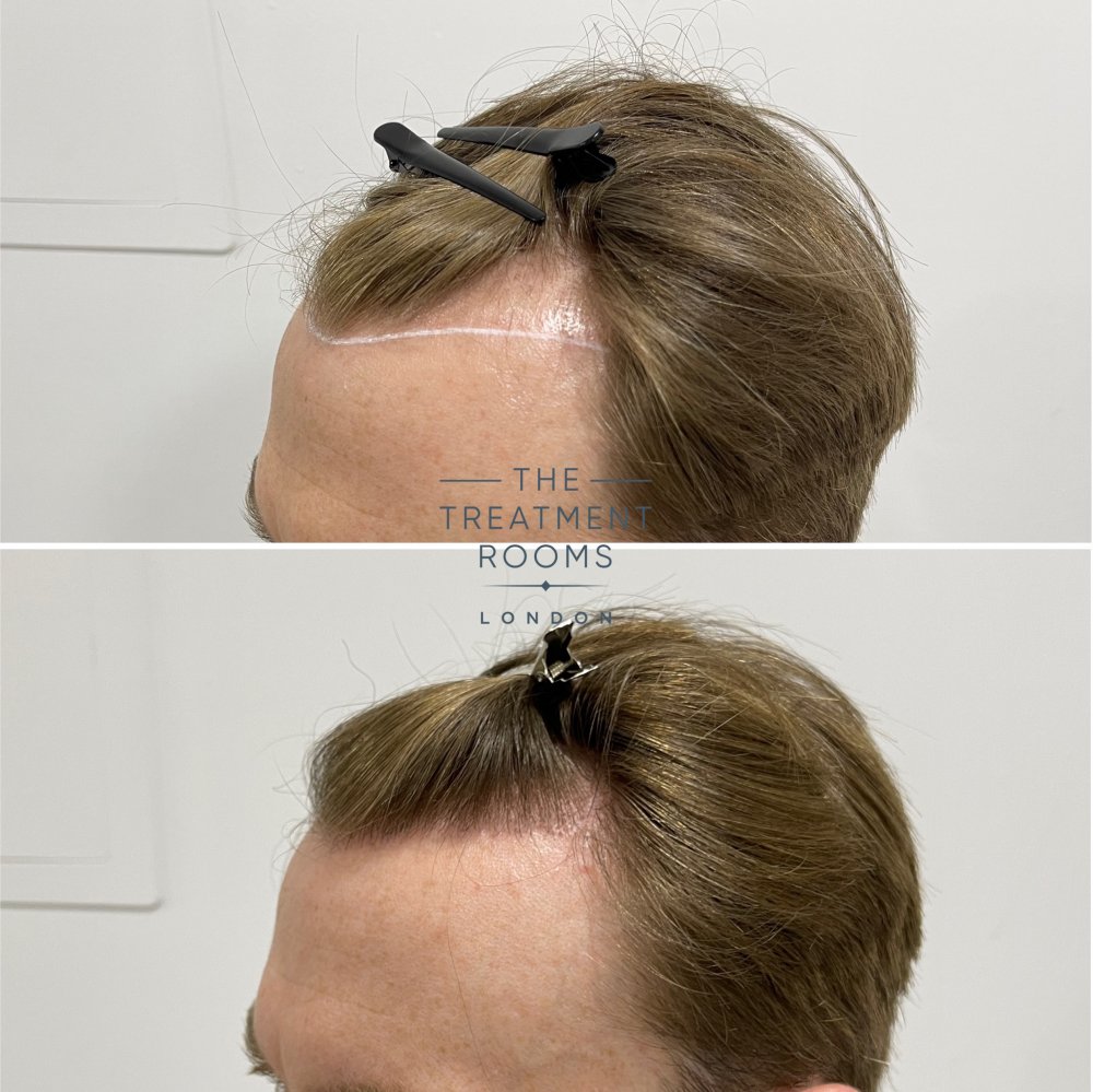 receding hairline fue hair transplant example 1700 grafts.jpg