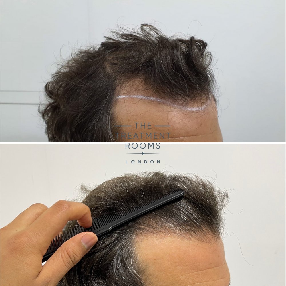 Receding hairline FUE hair transplant.jpg