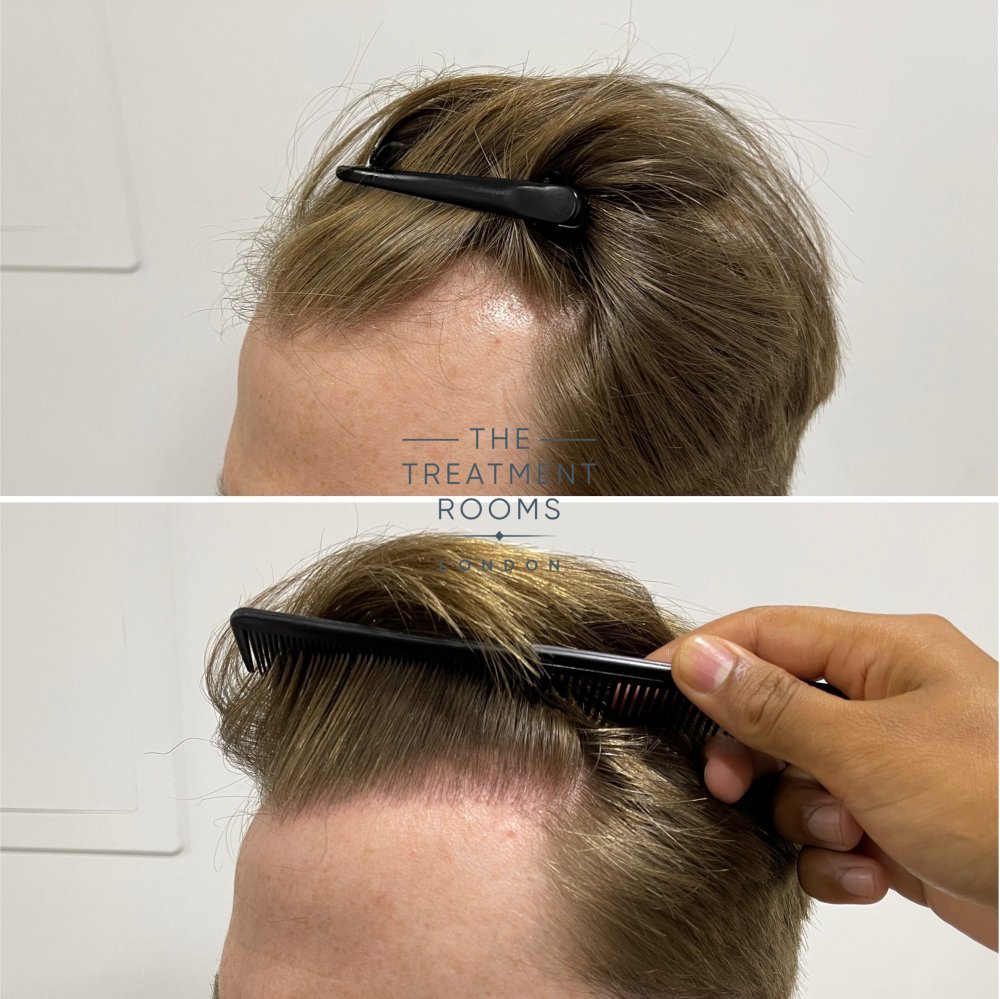 receding hairline fue hair transplant result 1700 grafts.jpg