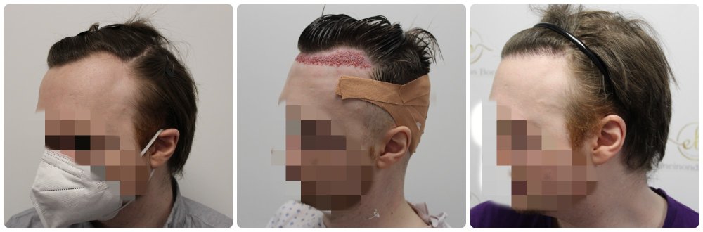 receding-hairline-fue-results.jpg
