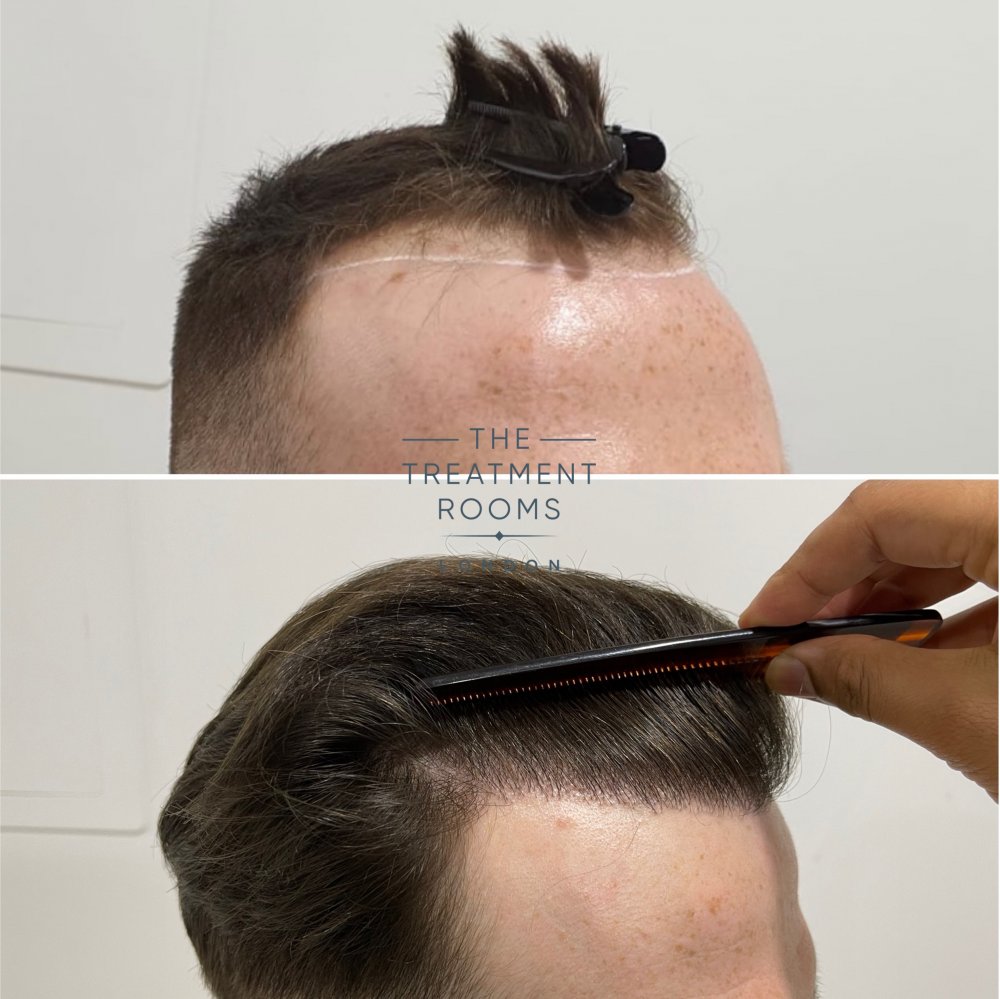 Receding hairline FUE surgery.jpg