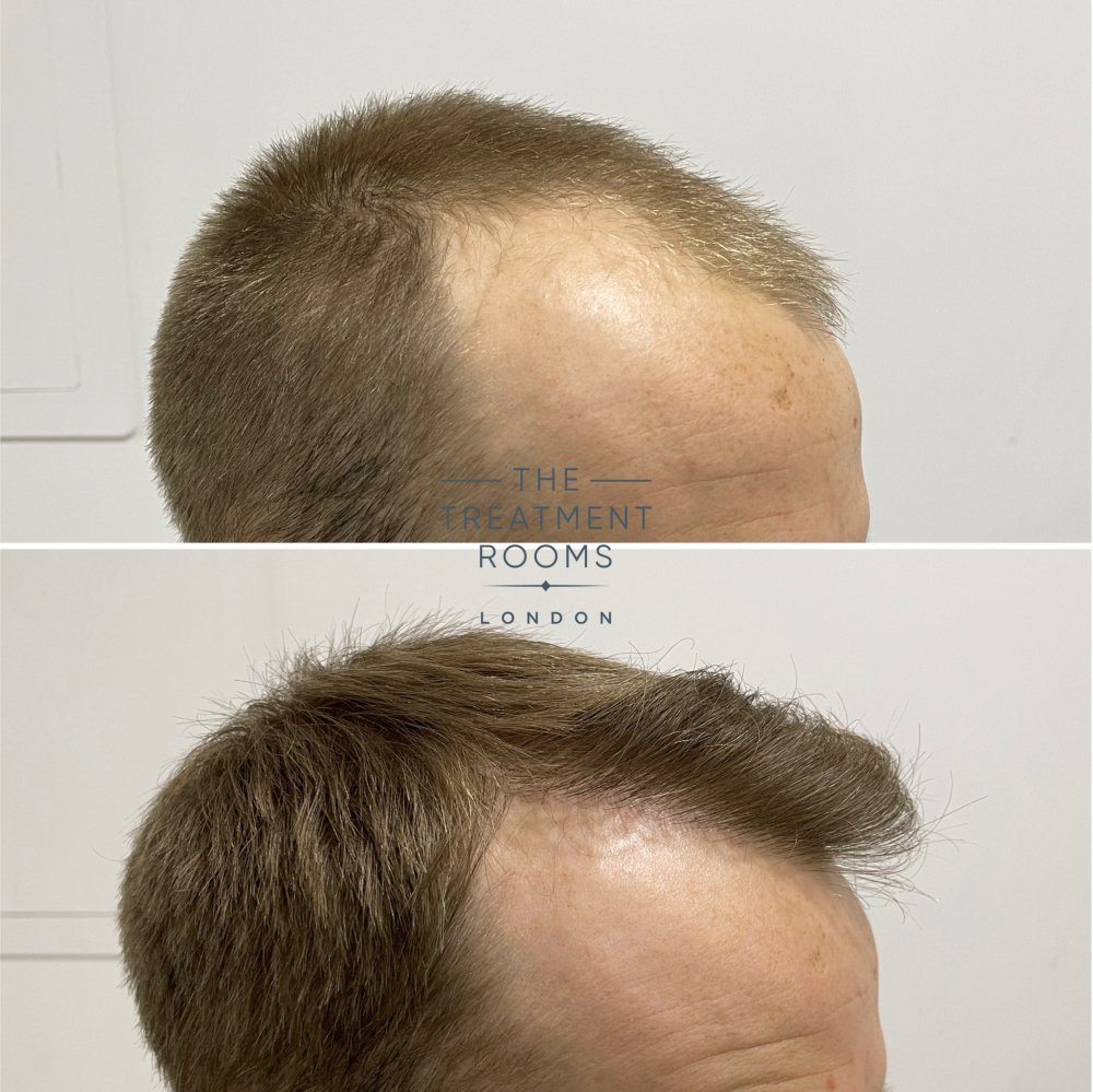 receding hairline fue transplant 1756 grafts result.jpg