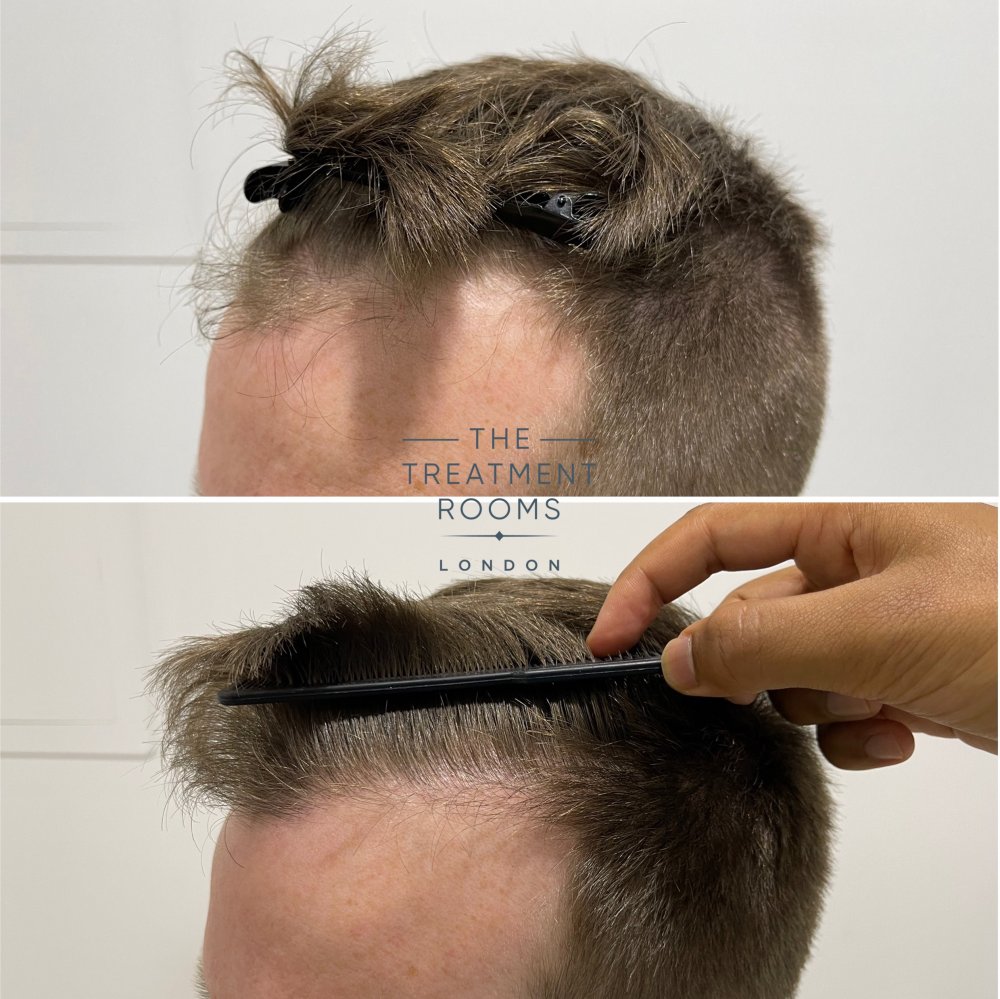 receding hairline hair transplant before and after closeup.jpg