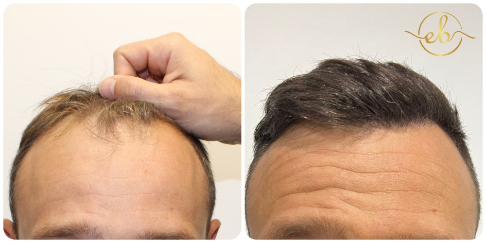Receding-Hairline-hair-transplant-dr-bonaros-glasgow.jpg