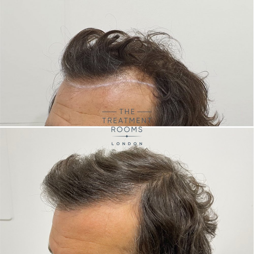 Receding hairline hair transplant.jpg