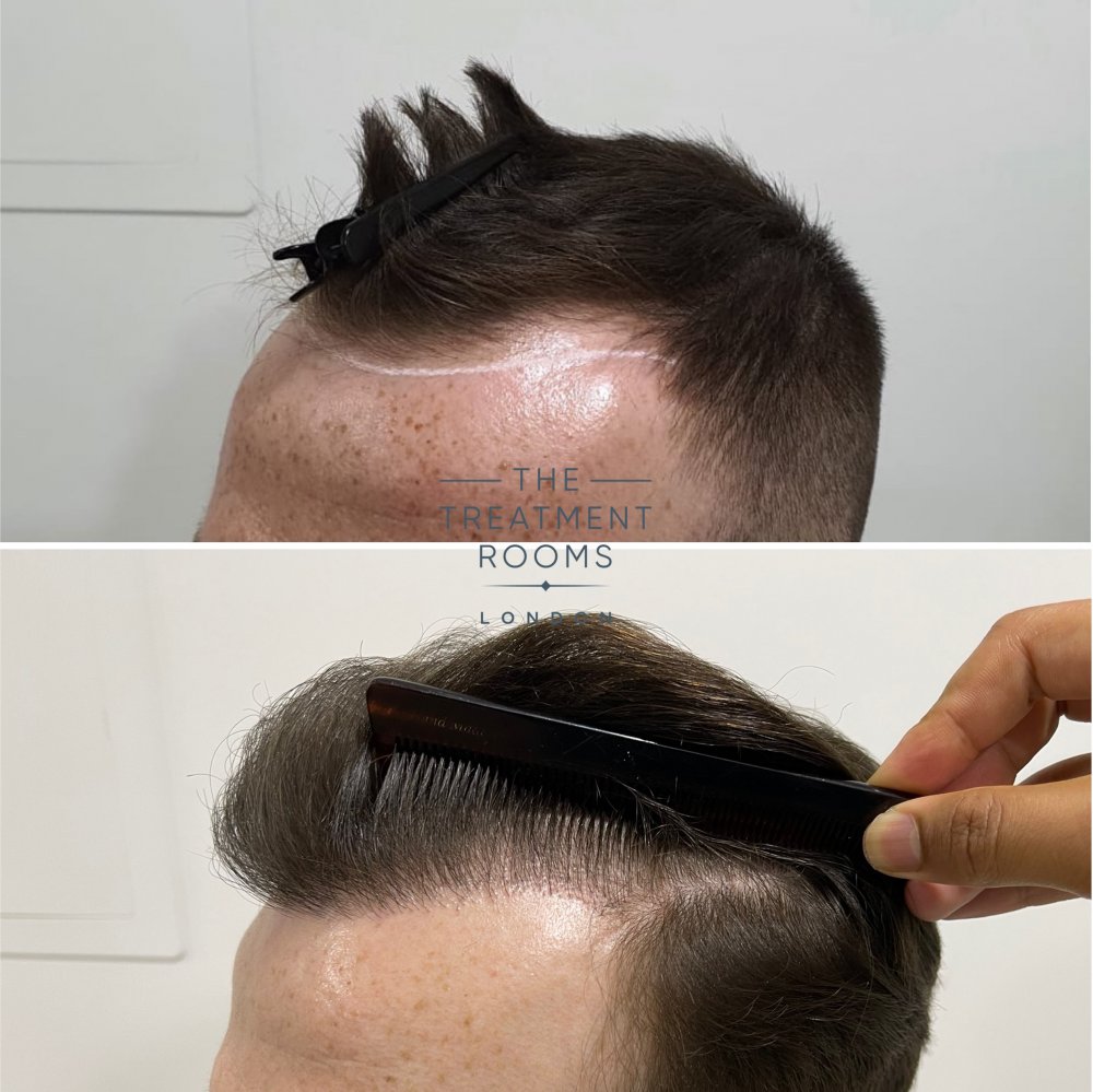 Receding hairline hair transplant.jpg