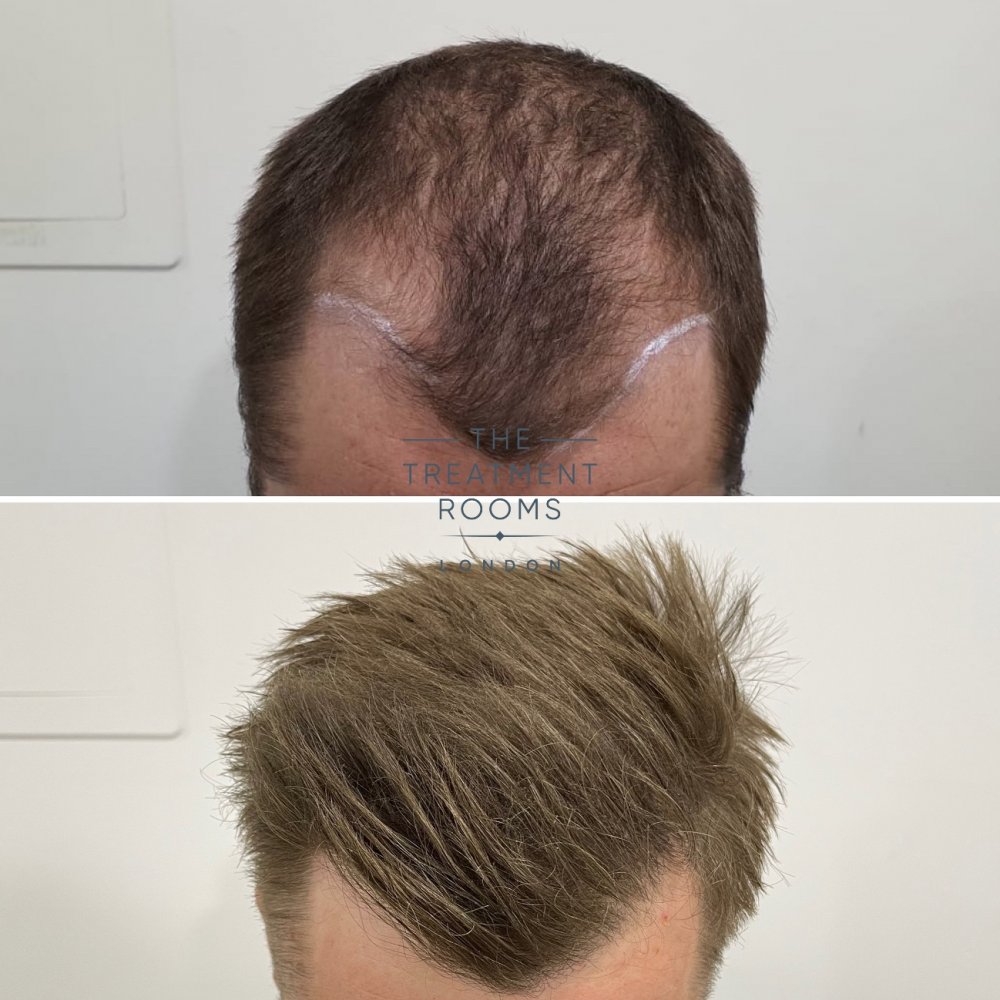 Receding hairline hair transplant result .jpg