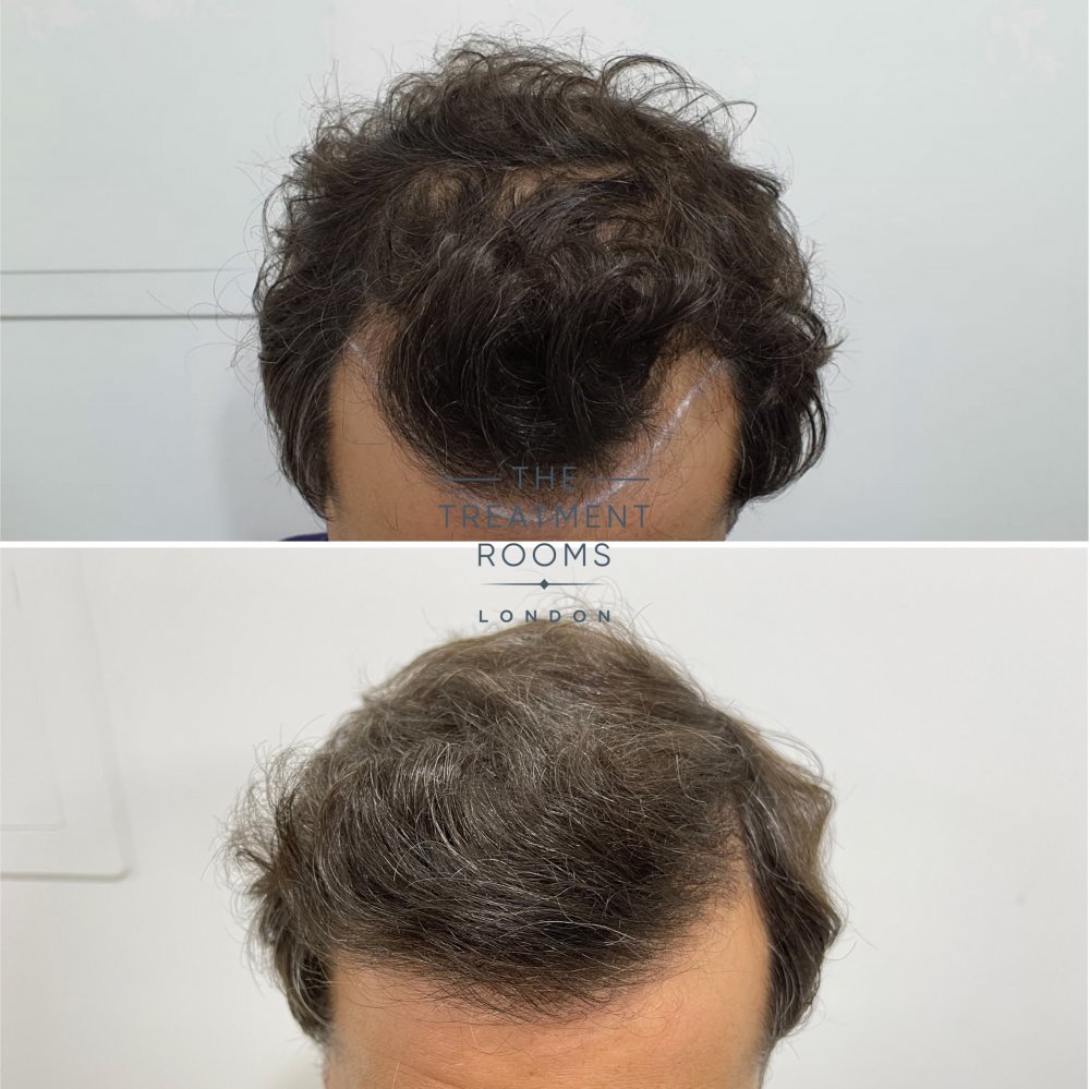 Receding hairline hair transplant result.jpg