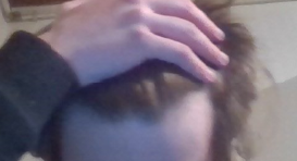 receding hairline.PNG