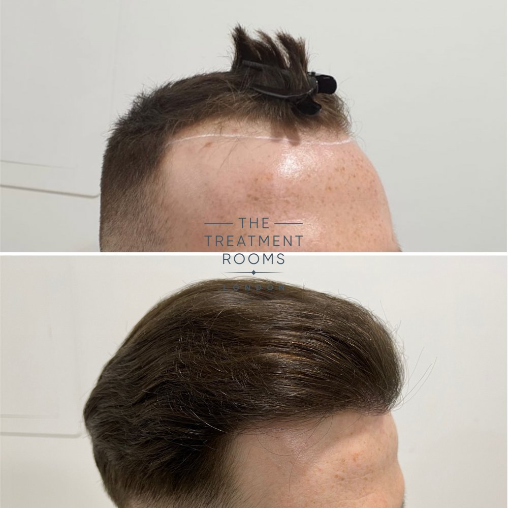 Receding hairline result.jpg