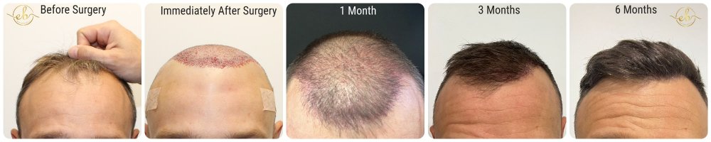 receding-hairline-scotland-dr-bonaros.jpg