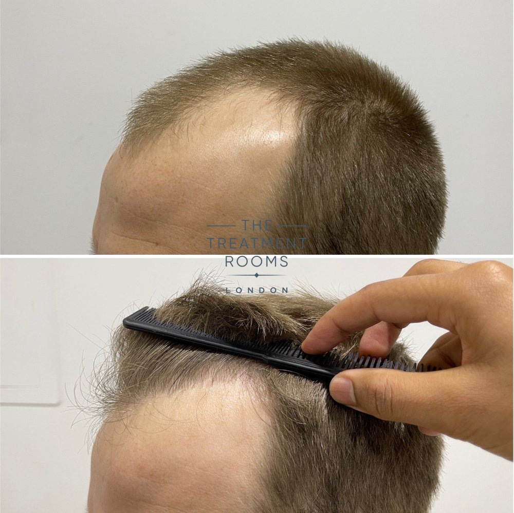 receding hairline transplant 1756 grafts result.jpg
