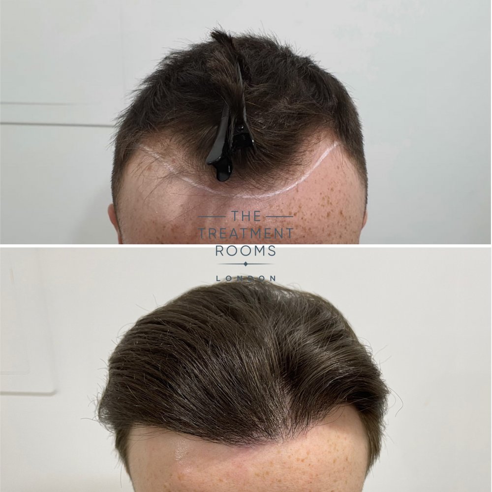 Receding hairline transplant.jpg