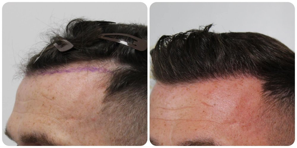 receding-hairline-treatment-glasgow.jpg