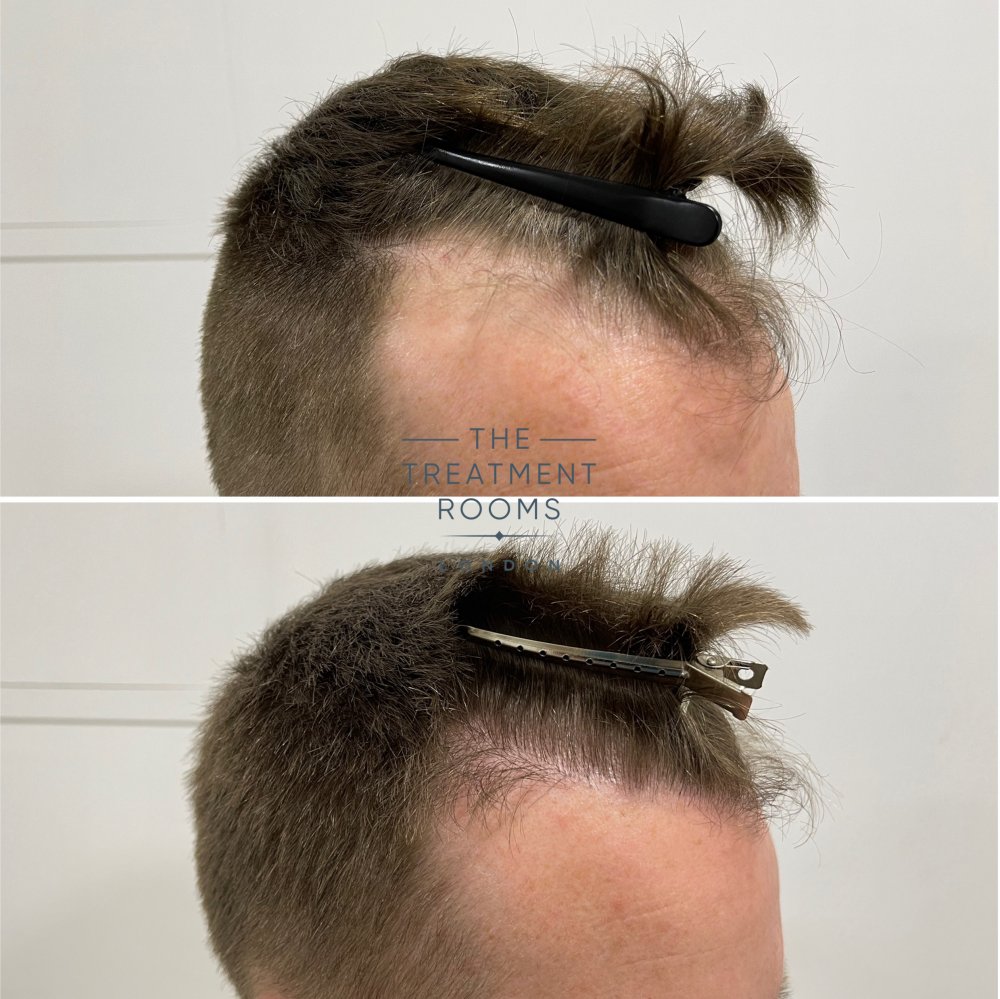 receding temples fue hair transplant before and after.jpg