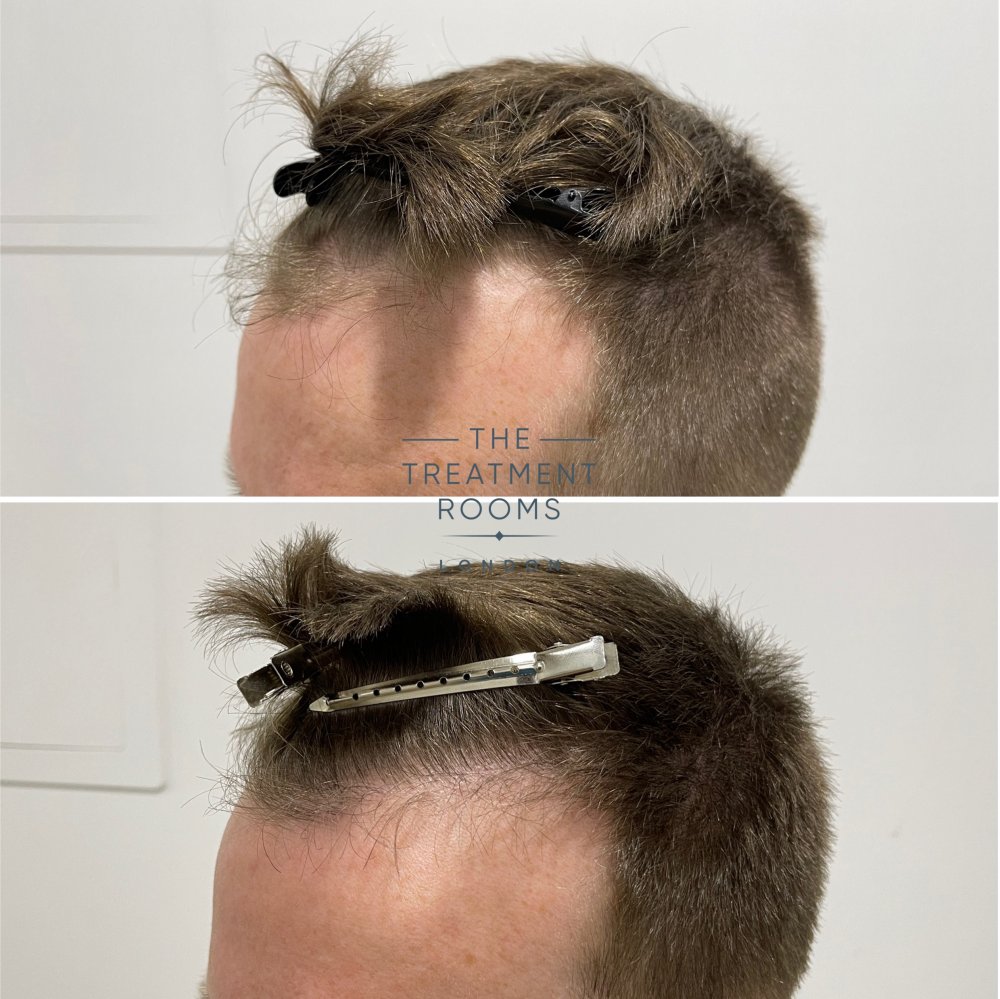 receding temples hair transplant before and after closeup.jpg