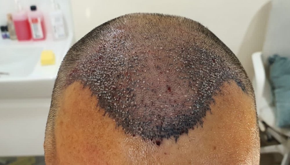 Recipient Area post surgery.jpg