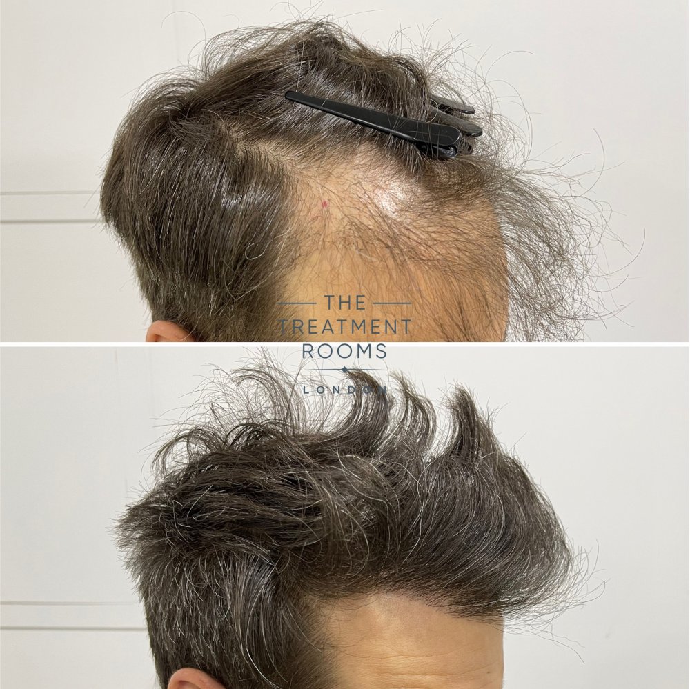 Repair FUE hair transplant before and after.jpg