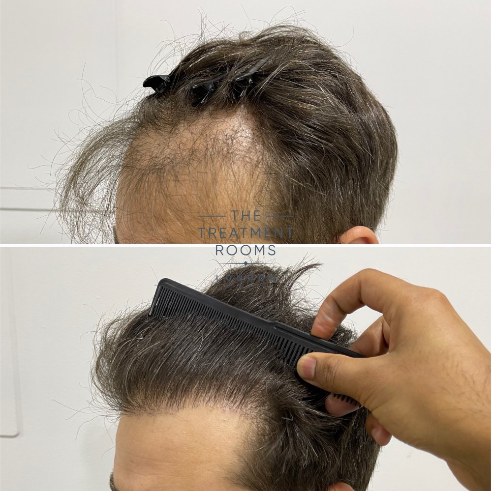 Repair Hair Transplant Hairline before and after.jpg