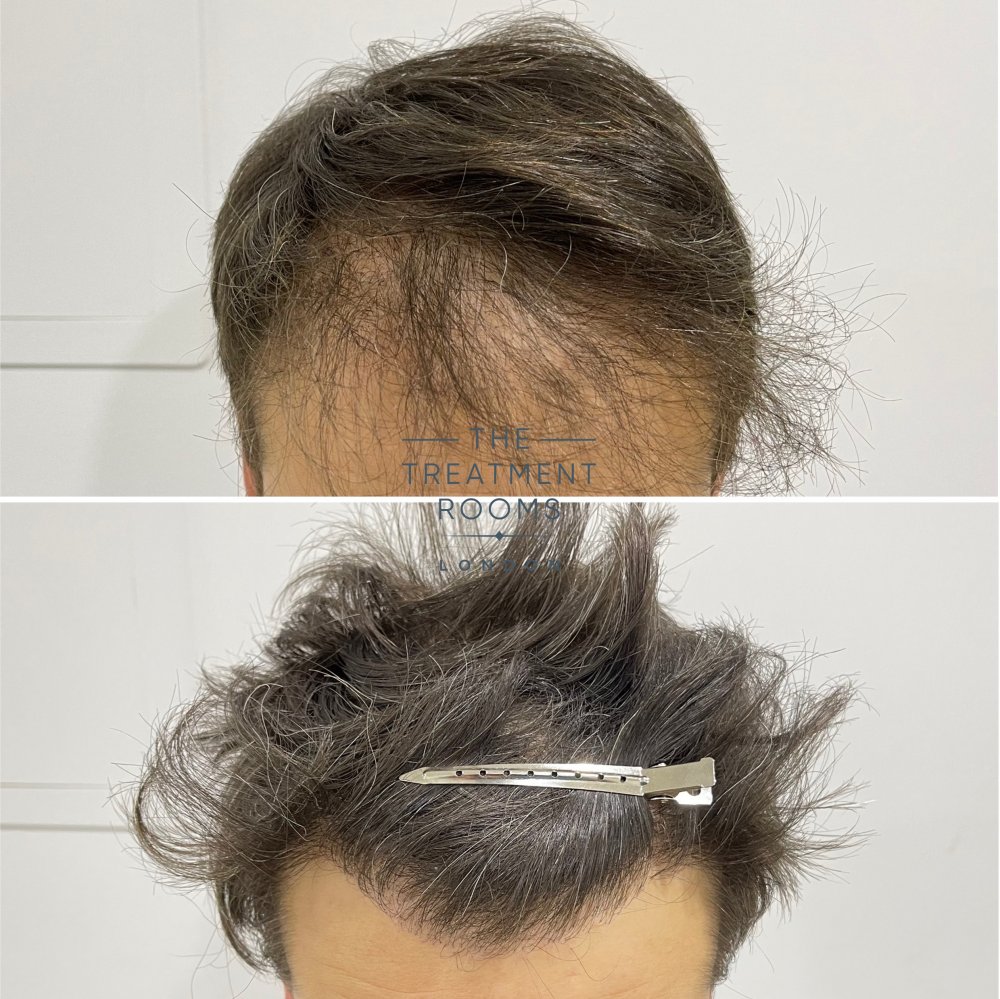 Repair Hair Transplant Hairline .jpg