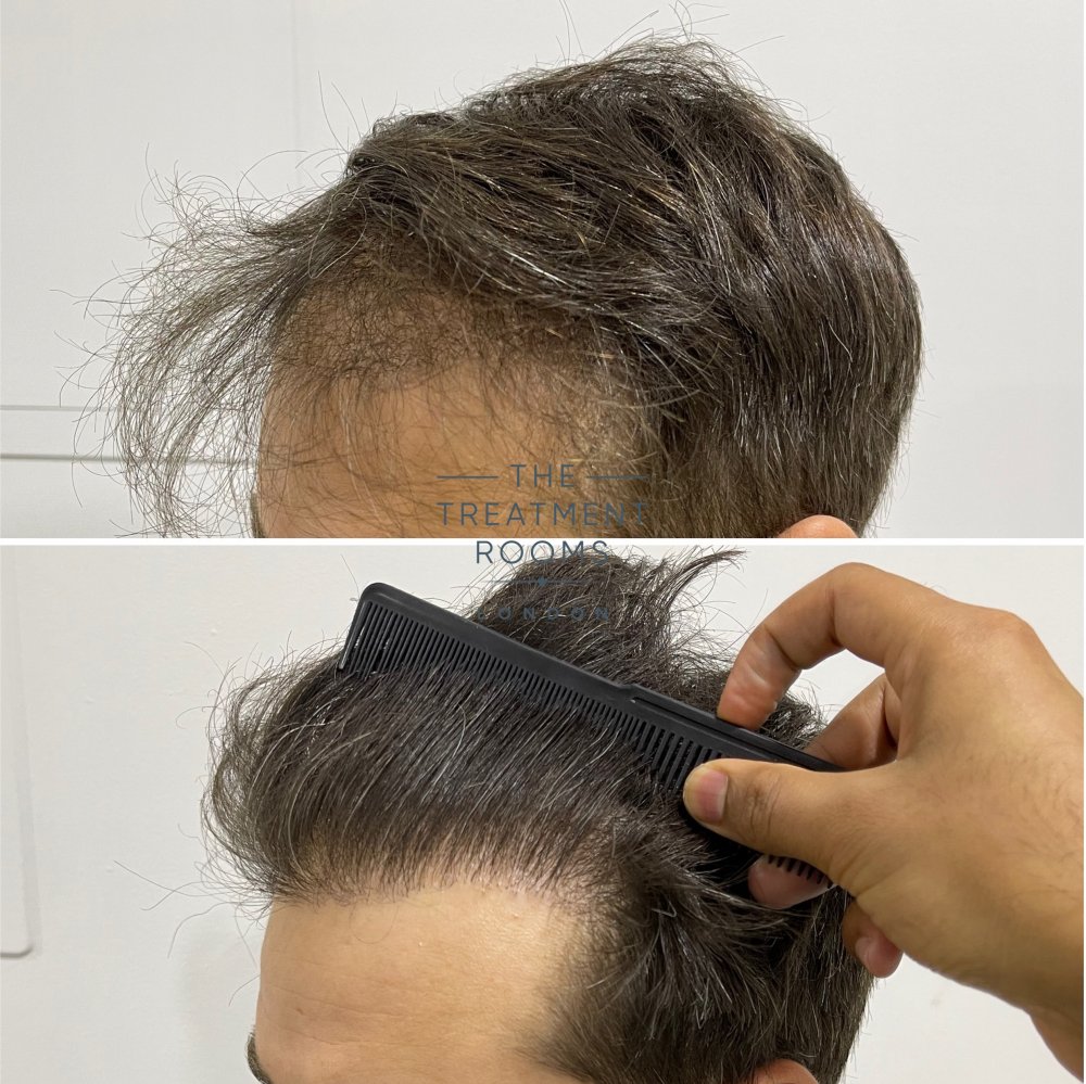 Repair Hair Transplant Hairline result.jpg