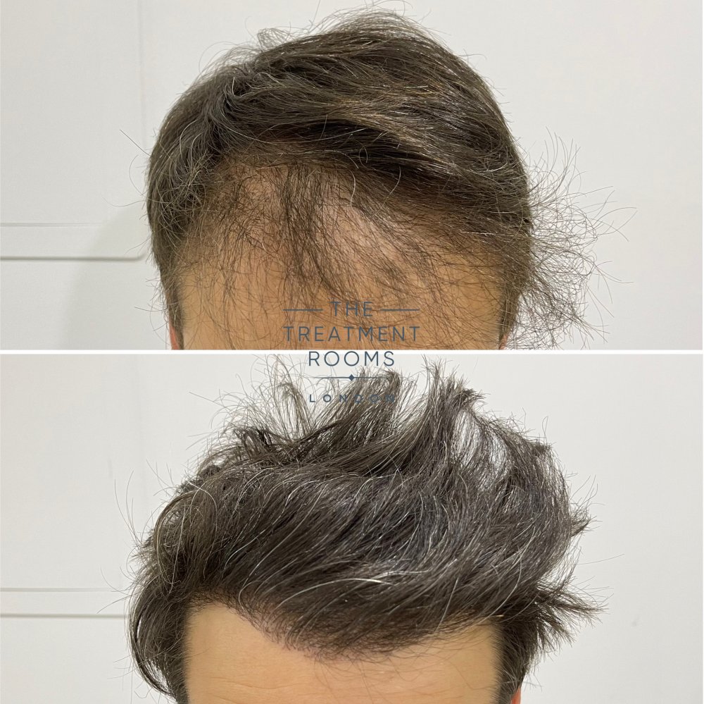 Repair Hair Transplant .jpg