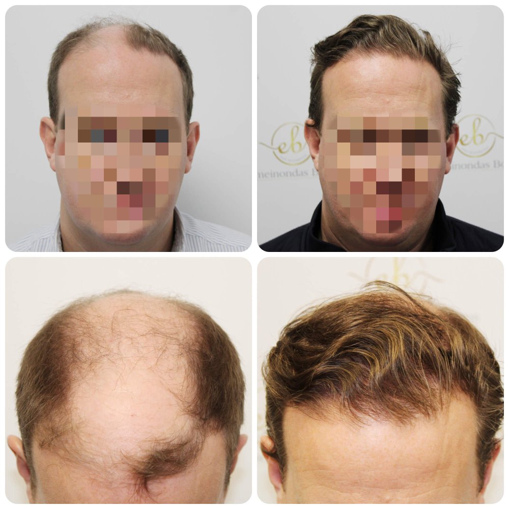 result-hair-transplant-dr-bonaros-glasgow-4000-grafts (3).jpg