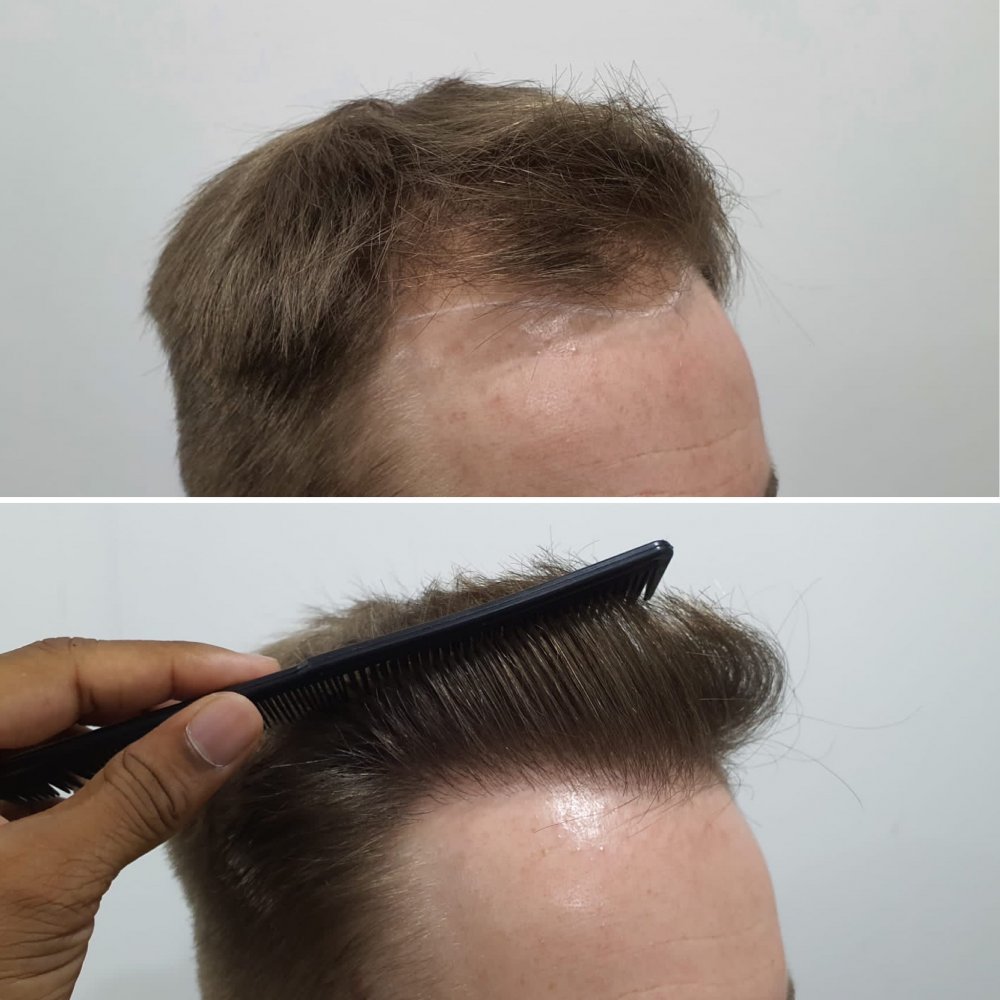 Right hairline 2.JPG