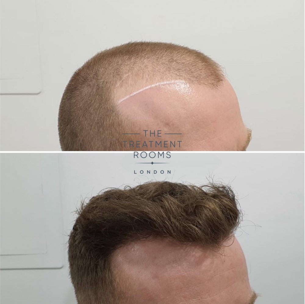 Right hairline 2.jpg