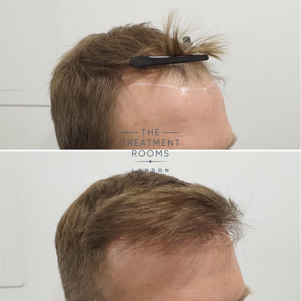 Right hairline before and after hair transplant.jpg