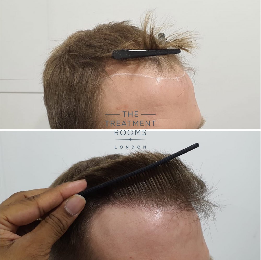 Right hairline closeup before and after FUE hair transplant.jpg