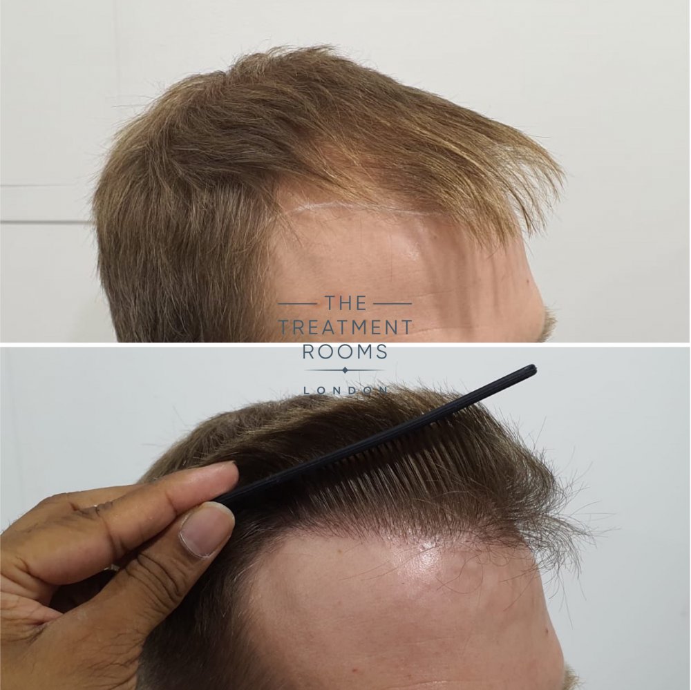 Right hairline closeup before and after hair transplant.jpg