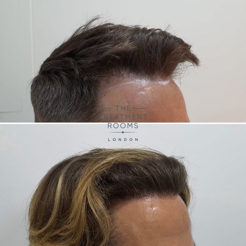 Right hairline DHI hair transplant before and after.jpg