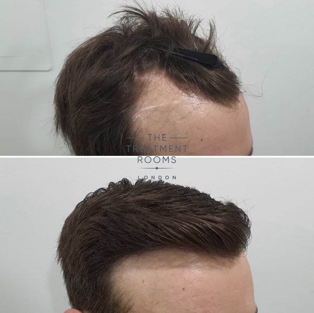 Right hairline FUE hair transplant 1100 grafts.jpg