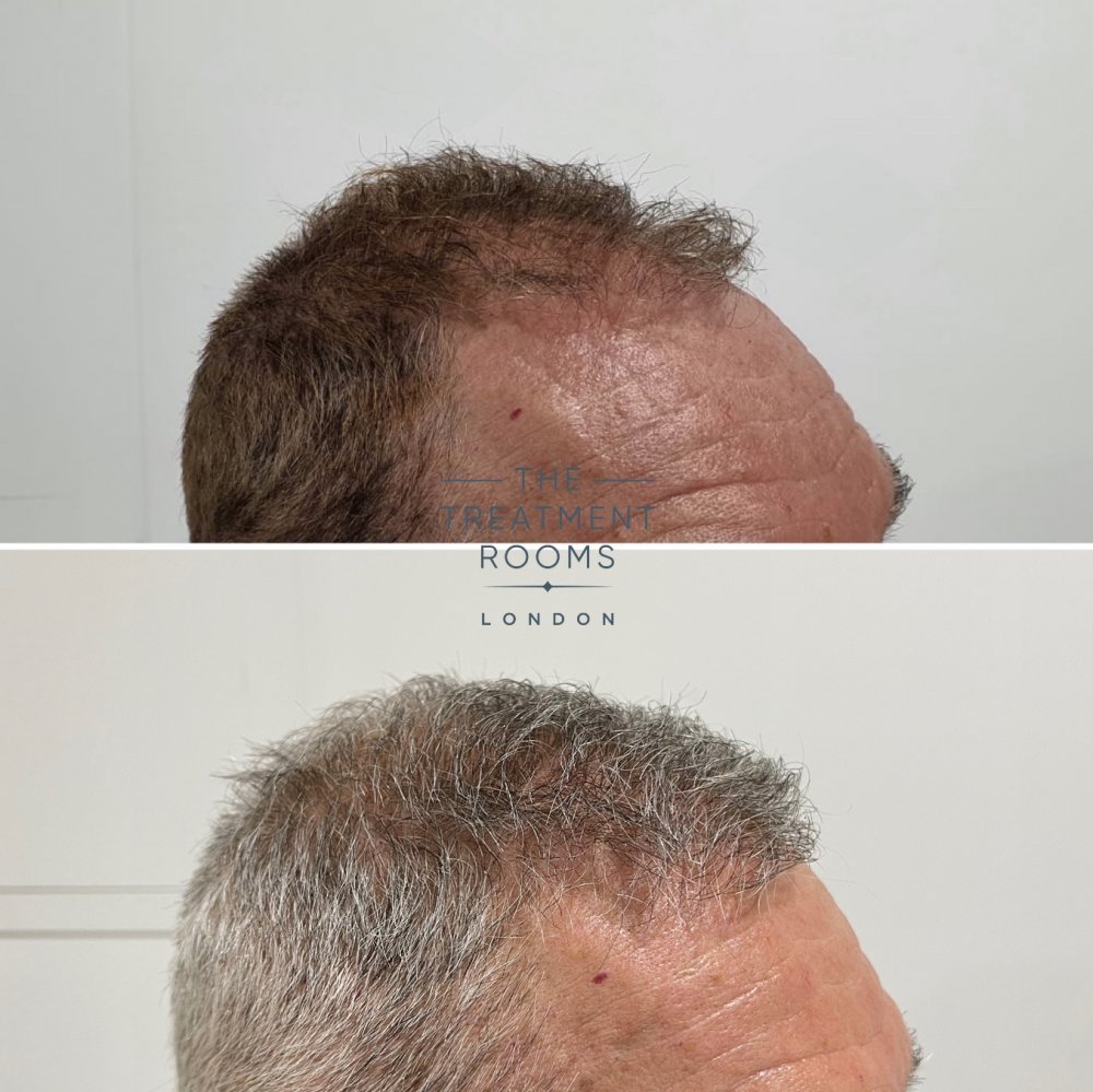 Right hairline fue hair transplant repair result.jpg