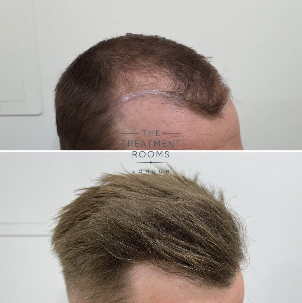 Right hairline FUE hair transplant result.jpg