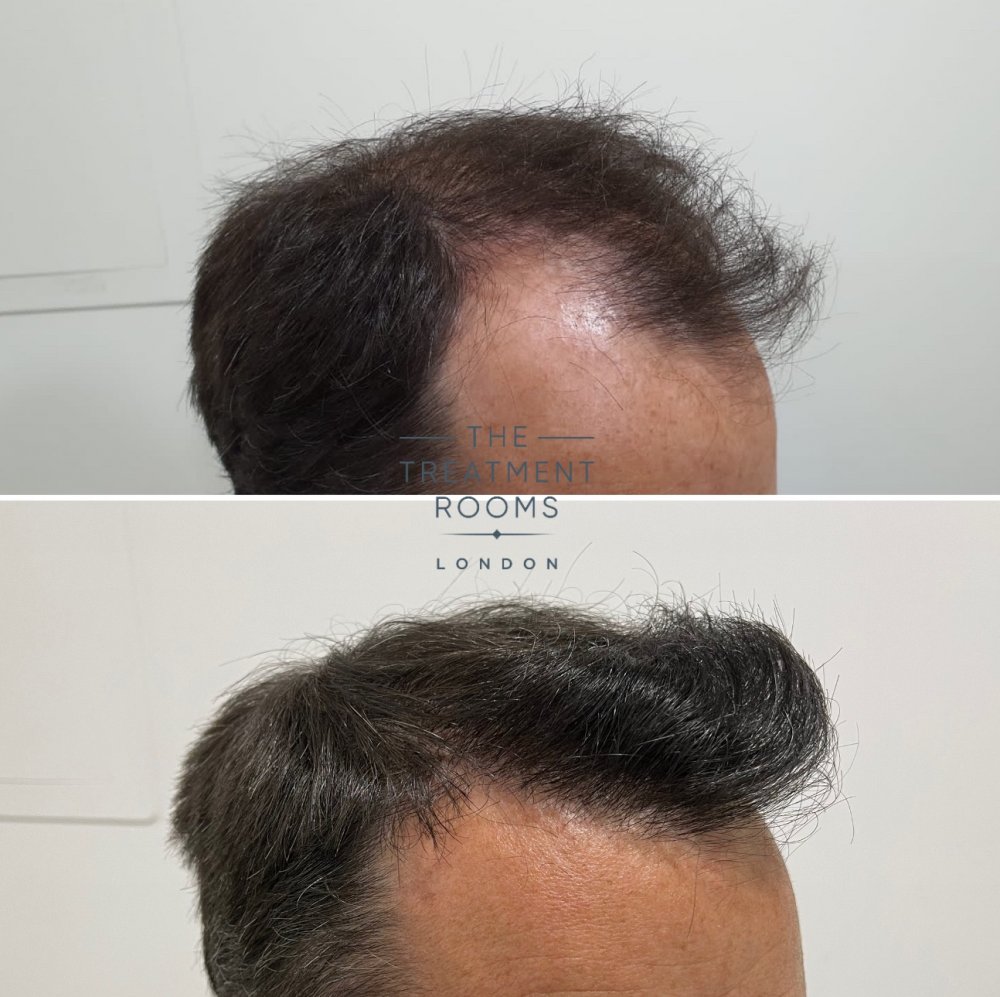 Right hairline hair transplant before and after.jpg