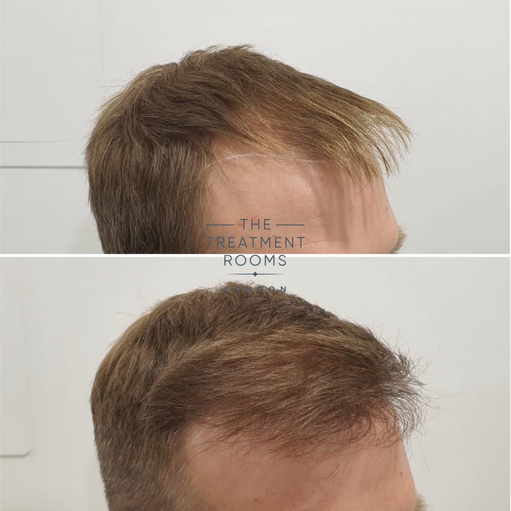 Right hairline hair transplant result.jpg