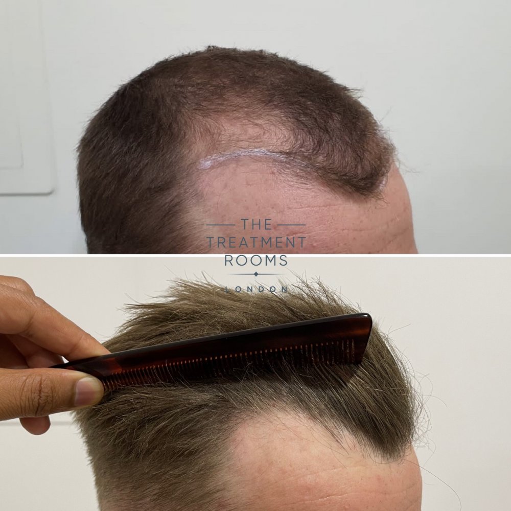 Right hairline hair transplant result with comb.jpg