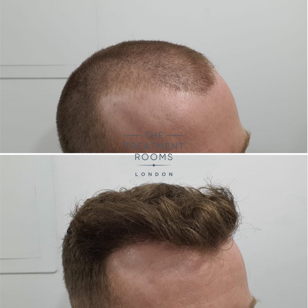 Right hairline. jpg.jpg