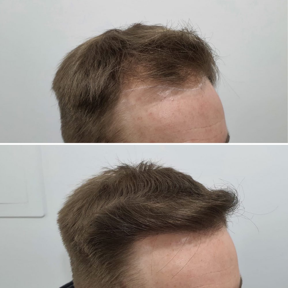 Right hairline.JPG