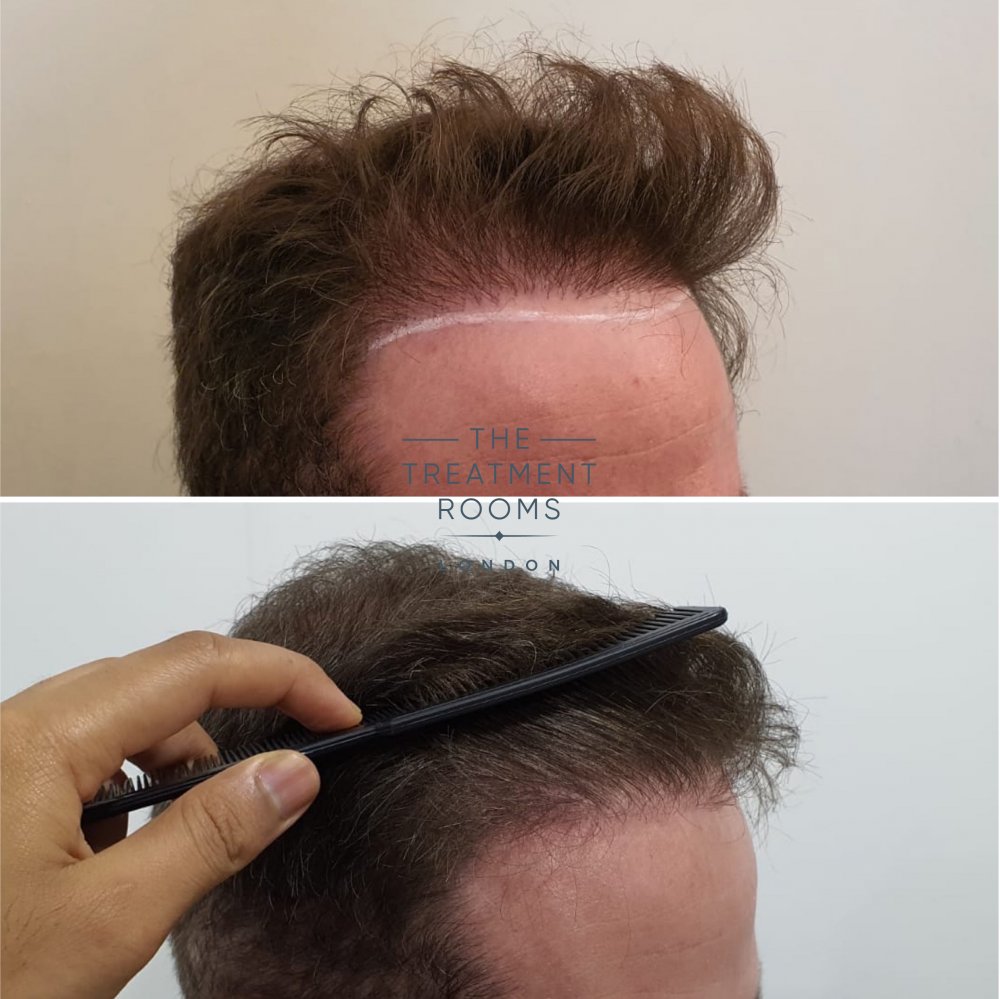 Right hairline repair hair transplant.jpg