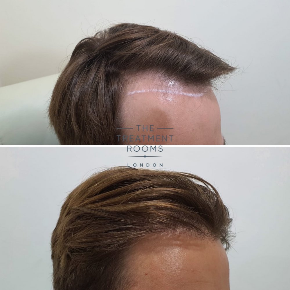 Right Hairline Result.jpg