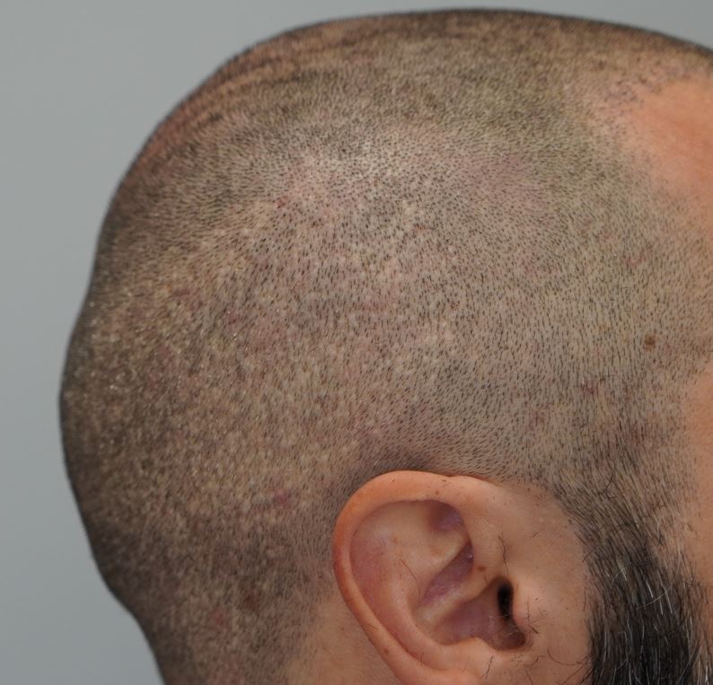 right side_presurgery shaved.JPG