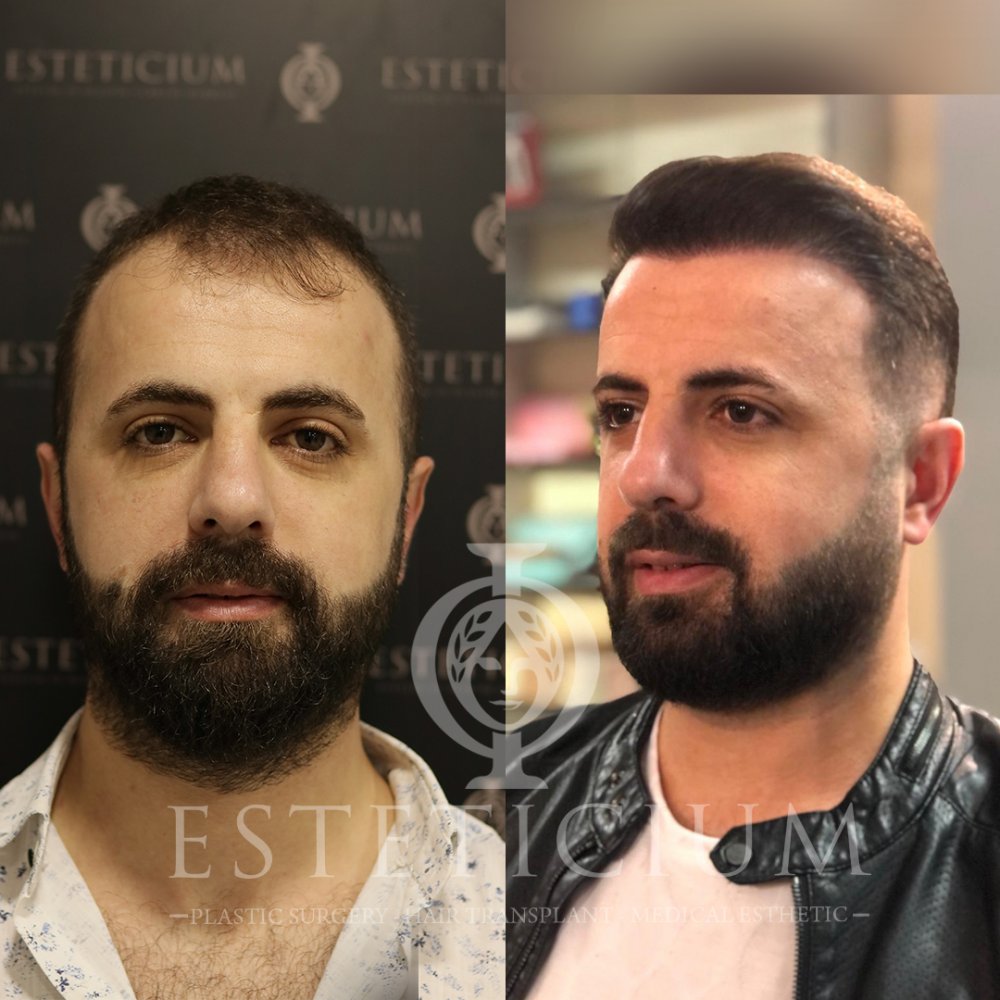 SAÇ EKİM-1.jpg